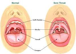 Sore Throat Relief Benefits Of Pineapple